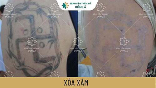 xóa xăm công nghệ cao