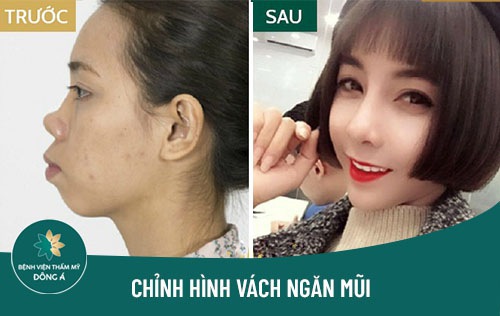 phẫu thuật chỉnh hình vách ngăn mũi