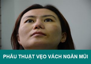 Phẫu thuật vẹo vách ngăn mũi giá bao nhiêu? Quy trình? Bao lâu thì lành