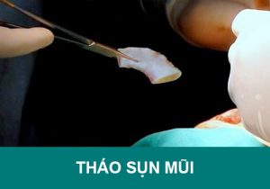 Tháo sụn mũi có trở lại bình thường không? Hình ảnh & chi phí