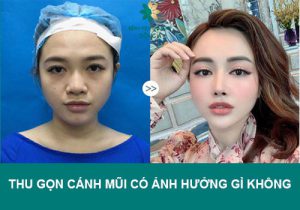 Thu gọn cánh mũi có ảnh hưởng gì không và câu trả lời không phải ai cũng biết