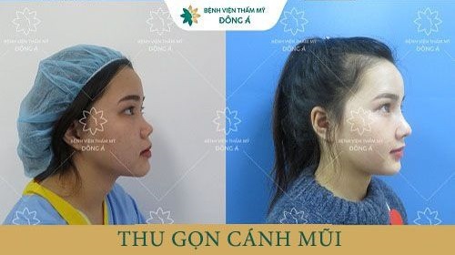 thu gọn cánh mũi vĩnh viễn