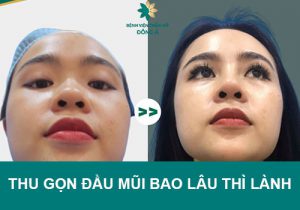 Thu gọn đầu mũi bao lâu thì Lành, Hết Sưng, Đẹp tự nhiên