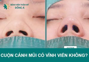 Thu gọn cánh mũi có vĩnh viễn không? Bác sĩ Đông Á giải đáp