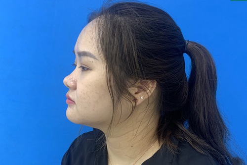 dáng mũi củ tỏi nhìn góc ngang