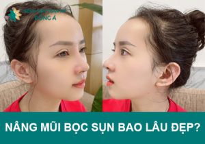 Nâng mũi bọc sụn bao lâu thì đẹp, mũi tự nhiên “không tì vết”