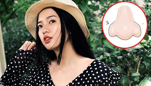 sửa mũi củ tỏi tốt hay xấu