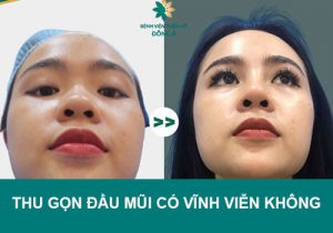 Thu gọn đầu mũi có vĩnh viễn không? Cách duy trì hiệu quả lâu dài