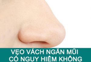 Vẹo vách ngăn mũi: Nguyên nhân, triệu chứng và cách điều trị