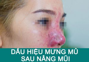 Cảnh báo 4 dấu hiệu bị mưng mủ sau khi nâng mũi & Cách xử lý an toàn