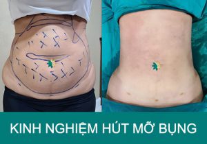 Tổng hợp kinh nghiệm hút mỡ bụng giảm hơn 10kg