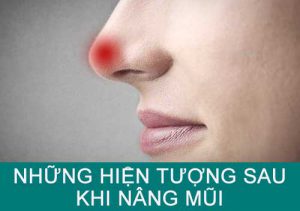 Những hiện tượng (xấu/tốt) sau khi nâng mũi: Cách nhận biết & Hướng xử lý