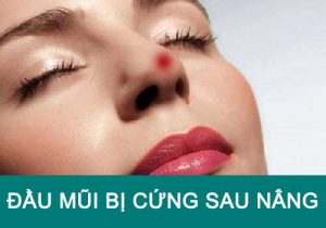 Đầu mũi bị cứng sau nâng có nguy hiểm không? Nguyên nhân & Cách khắc phục