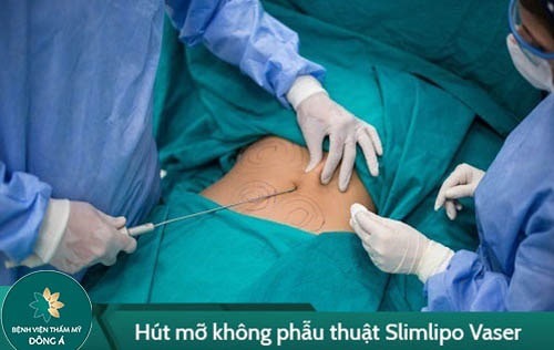 công nghệ hút mỡ giảm béo