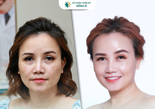 cấy HA