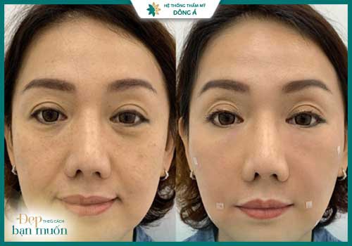 căng da mặt đà nẵng tốt nhất