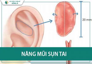 Nâng mũi bằng sụn tai được bao lâu – giải đáp thắc mắc về nâng mũi bằng sụn tai