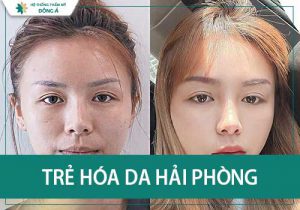 Trẻ hóa da an toàn, hiệu quả cùng TMV Đông Á Hải Phòng