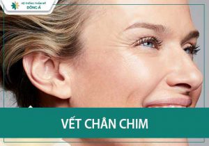 Vết chân chim là gì? Cách xóa dấu chân chim ở mắt hiệu quả