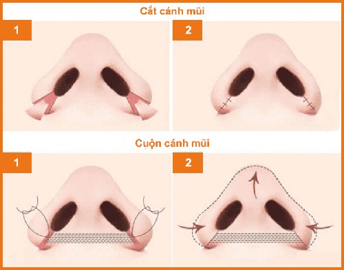 cuộn cánh mũi nội soi