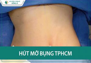 Hút mỡ bụng ở đâu an toàn: Lựa chọn địa chỉ uy tín hàng đầu