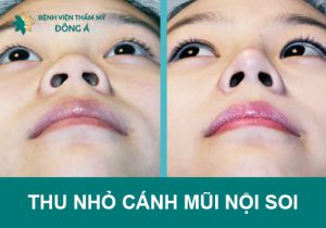 Thu gọn cánh mũi nội soi đẹp, nhanh chóng nhưng có an toàn?