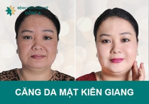 Địa chỉ căng da mặt/nâng cơ tại Kiên Giang uy tín, an toàn, hiệu quả