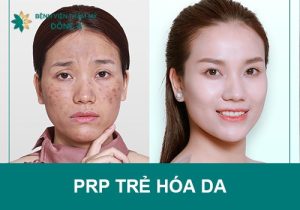 Trẻ hóa da bằng PRP: Cấy Huyết Tương tiểu cầu phục hồi tuổi xuân
