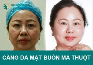 Căng da mặt Buôn Ma Thuột công nghệ cao trẻ hóa tới 15 tuổi