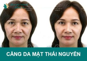 Căng da mặt Thái Nguyên không đau, an toàn tại Đông Á 