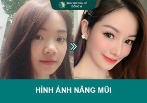 Bộ sưu tập hình ảnh nâng mũi trước – sau tại Bệnh viện thẩm mỹ