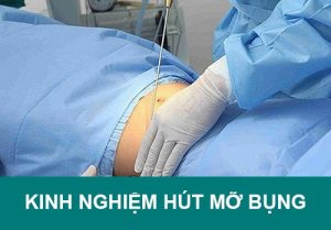 9+ Kinh nghiệm hút mỡ bụng an toàn chia sẻ từ chuyên gia