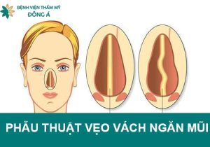 Phẫu thuật vẹo vách ngăn mũi: chi phí & quy trình mổ vẹo 2022