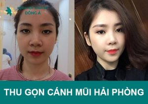 Thu gọn cánh mũi Hải Phòng ĐẸP – KHÔNG ĐAU – AN TOÀN