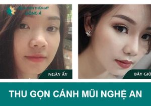 Địa chỉ thu gọn cánh mũi Nghệ An – mũi thon gon, cân đối vĩnh viễn