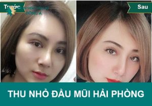 Thu nhỏ đầu mũi Hải Phòng thay đổi vận số – thăng hạng nhan sắc