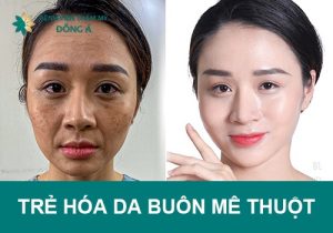 Địa chỉ trẻ hóa da Buôn Ma Thuột – nâng cơ xóa nhăn công nghệ cao