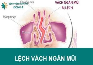 Vẹo lệch vách ngăn mũi: Nguyên nhân, triệu chứng và cách điều trị