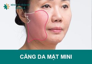 Căng da mặt mini – “Phép tiên” dành cho chị em mới bị lão hóa