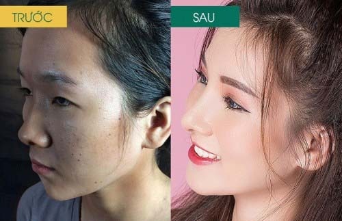 khách hàng sửa mũi