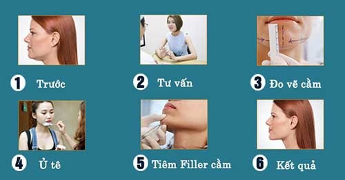 tiêm filler ở đâu an toàn