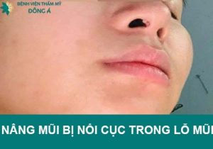 Sau nâng mũi bị nổi cục trong lỗ mũi phải làm sao?