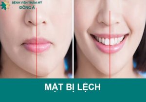Mặt bị lệch: 5 Nguyên nhân và 5 Cách khắc phục tại nhà an toàn
