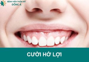 Cười hở lợi là gì? Tướng số Nam/Nữ ra sao? Cách điều trị an toàn