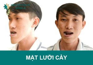 Mặt lưỡi cày là gì? Tướng tốt hay xấu? Để kiểu tóc nào?