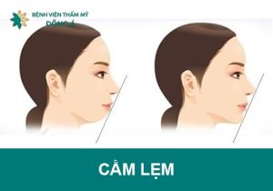 Cằm lẹm là gì? Tướng số tốt hay xấu? Cách khắc phục triệt để