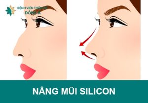 Nâng mũi silicon là gì? Được bao lâu? Có nên nâng không?