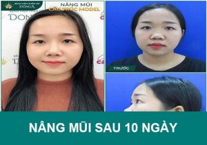 Nâng mũi sau 10 ngày nhìn như thế nào? Đẹp chưa?