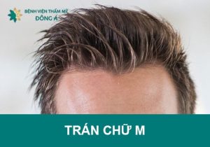Trán chữ M nên để tóc gì? Xấu hay đẹp? Xem tướng nam, nữ