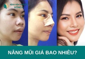 Nâng mũi giá bao nhiêu tiền? Bảng chi phí sửa mũi mới nhất 2023